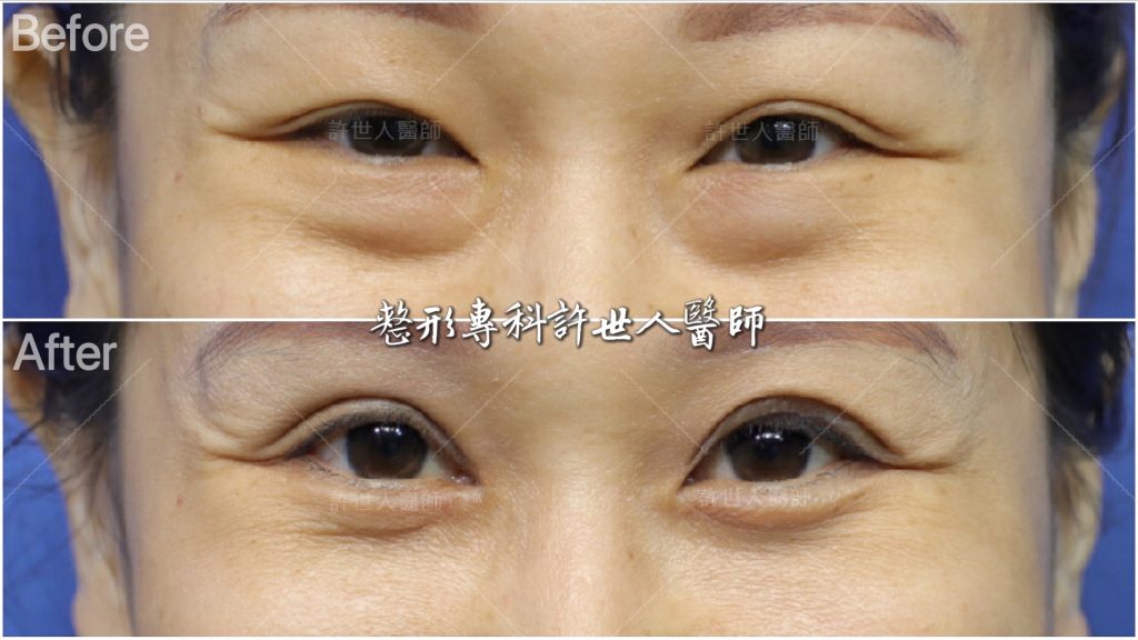 內開眼袋脂肪移位手術＋ 提眼瞼肌+雙眼皮手術  許世人醫師案例分享