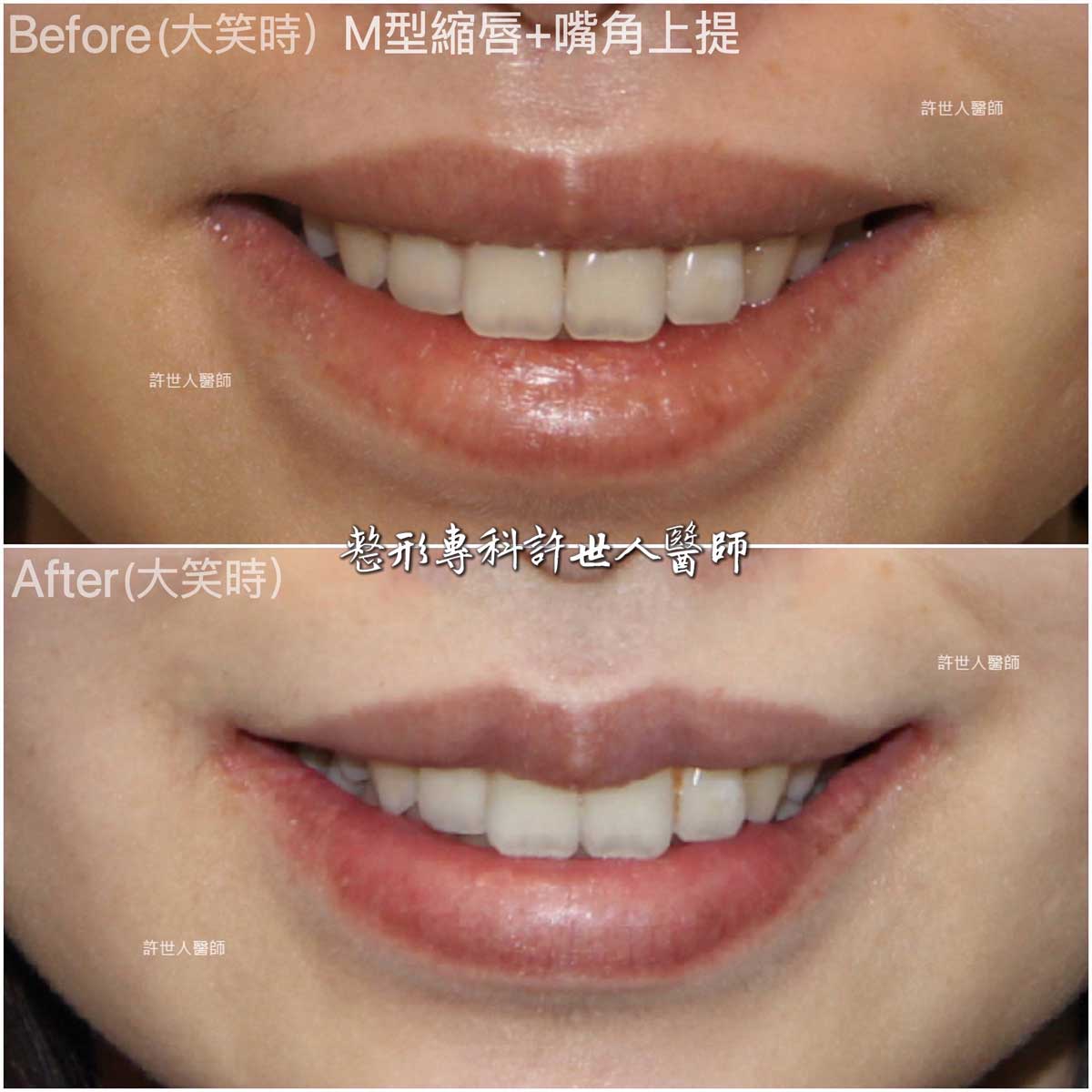 嘴角上提+-M型縮唇手術治療嘴角下垂