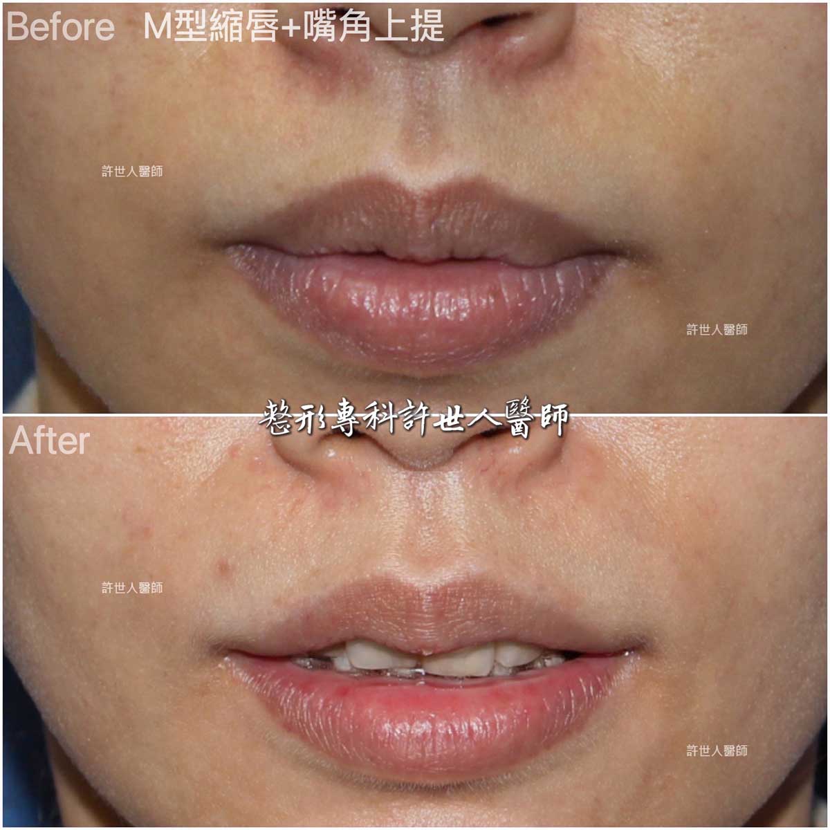 12–嘴角上提+-M型縮上唇 嘴角上提手術+-M型縮上唇治療嘴角下垂