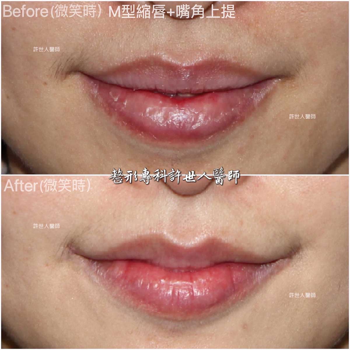 嘴角上提手術+-M型縮上唇治療嘴角下垂