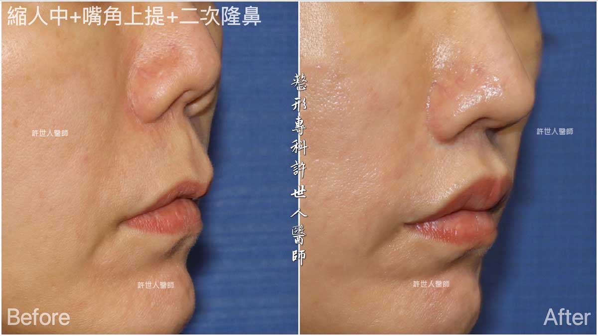4縮人中+嘴角上提+二次隆鼻-2 縮人中+嘴角上提+二次隆鼻