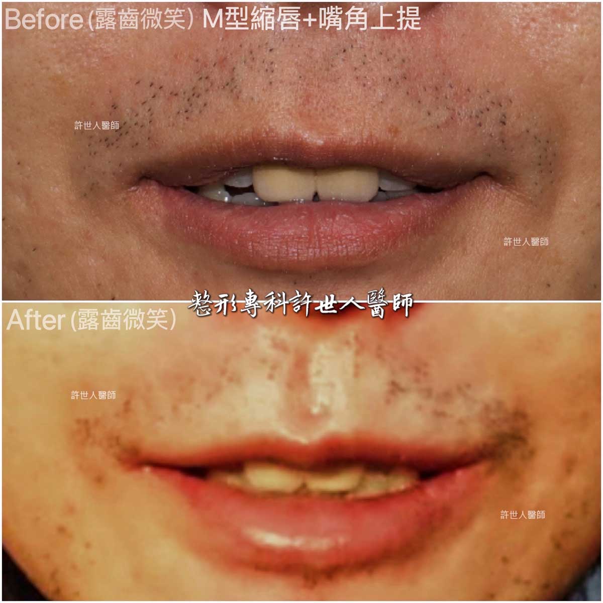 6-嘴角上提+-M型縮上唇-露齒 嘴角上提+-M型縮上唇治療嘴角下垂