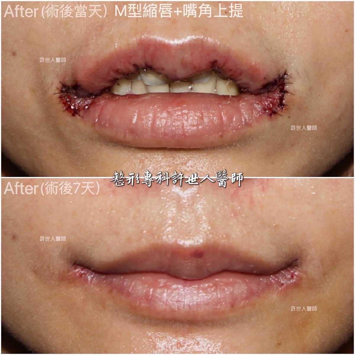嘴角上提+-M型縮上唇治療嘴角下垂