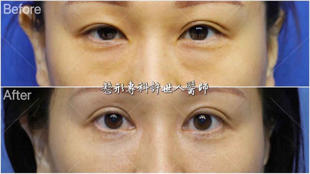 內開眼袋脂肪移位手術＋ 提眼瞼肌+雙眼皮手術