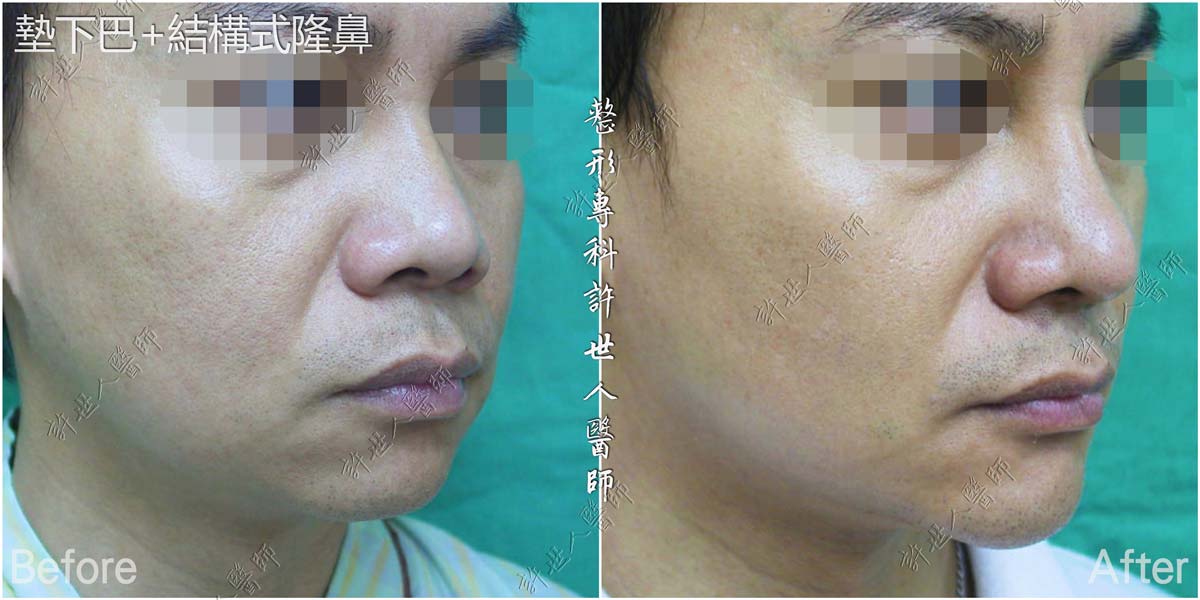 墊下巴-結構式隆鼻手術 許世人醫師案例分享 墊下巴-結構式隆鼻手術 許世人醫師案例分享