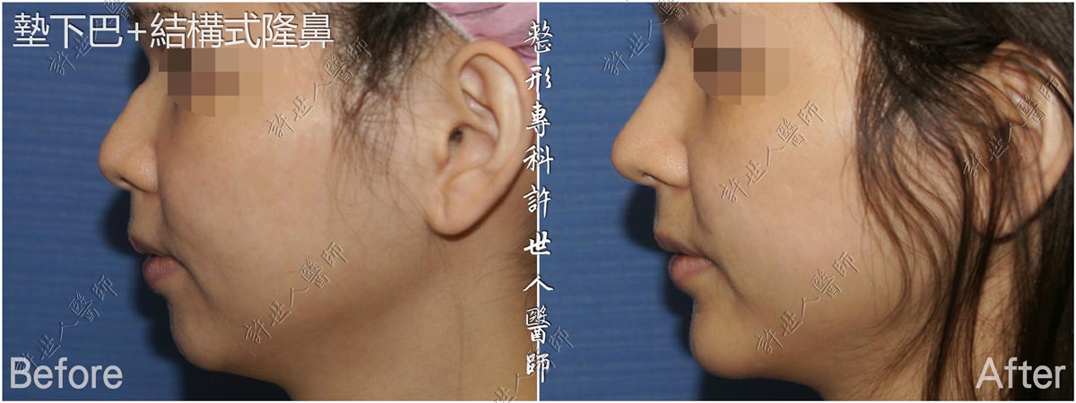 11墊下巴-結構式隆鼻手術 許世人醫師案例分享 11墊下巴-結構式隆鼻手術 許世人醫師案例分享