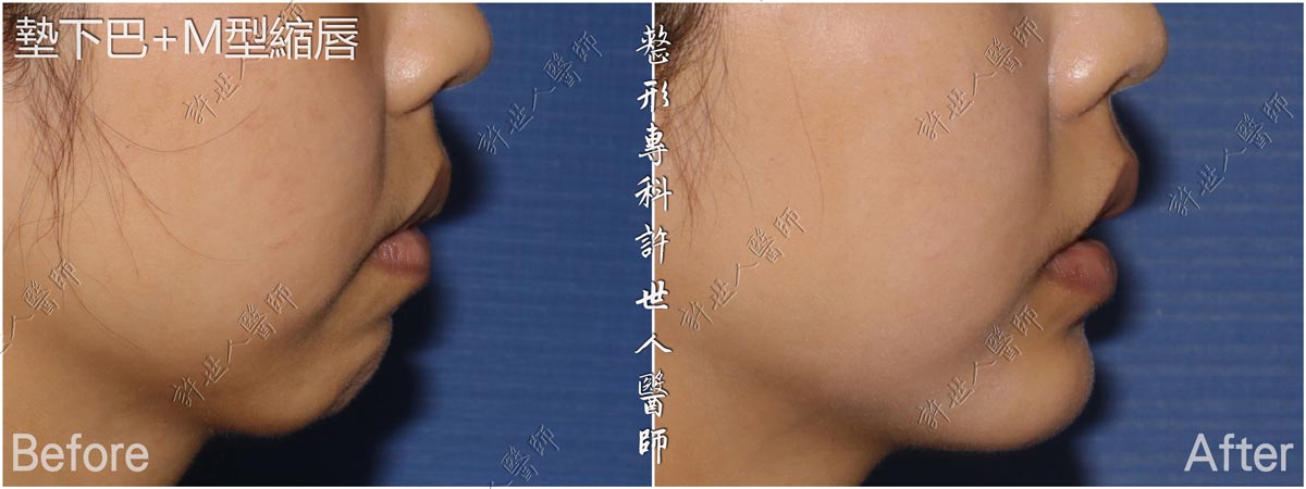 13墊下巴-M型縮唇手術許世人醫師案例分享
