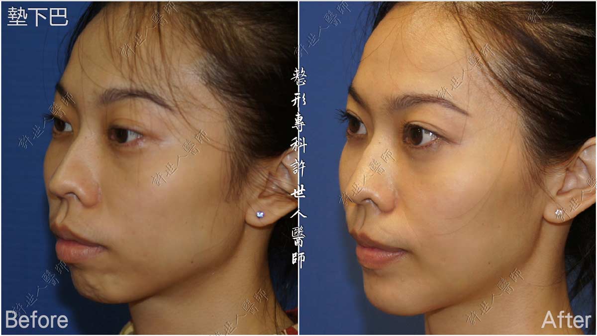 墊下巴手術 許世人醫師案例分享