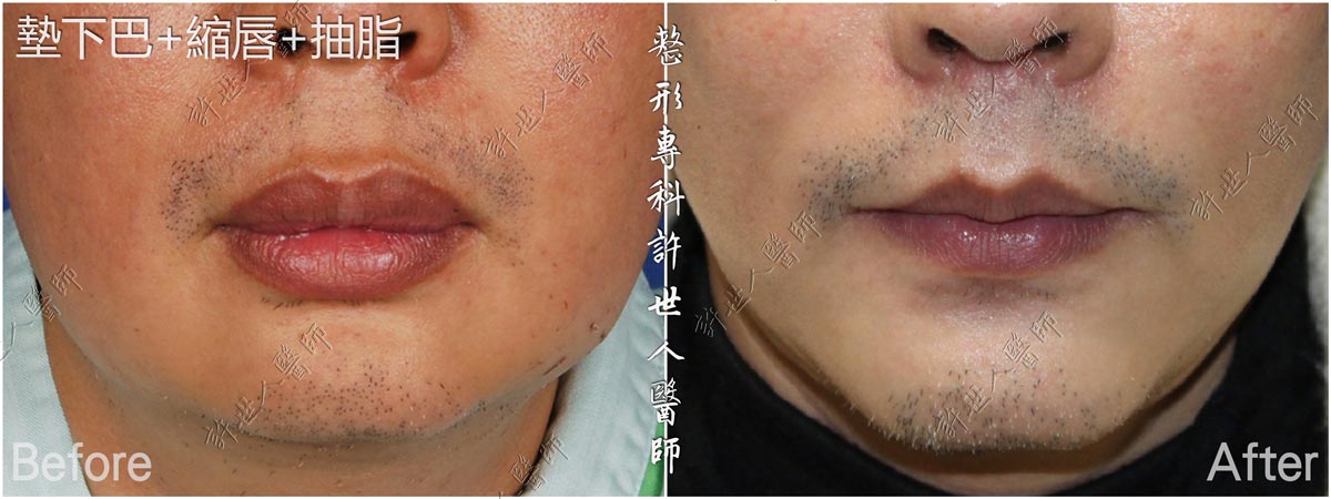 20墊下巴-縮唇-抽脂手術許世人醫師案例分享