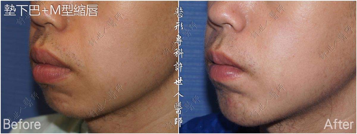 22墊下巴-M型縮唇手術許世人醫師案例分享